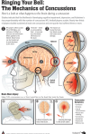 Concussion Poster