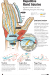 Repetitive Hand Injuries
